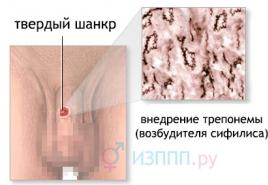 Методы диагностики сифилиса, их преимущества и недостатки